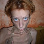 anorexia